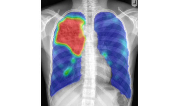 imagen pulmones